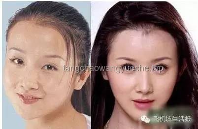 演员孙菲菲整容风波背后的真相：库欣式综合征知多少？